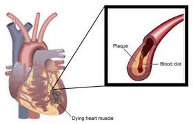 *Imagem de uma placa de ateroma rompida com formação de um trombo no local e infarto da área irrigada pela artéria.